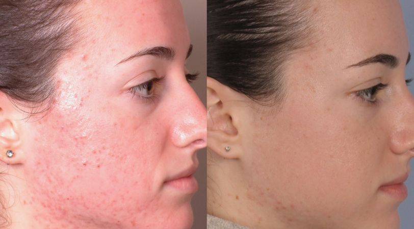 Before &After